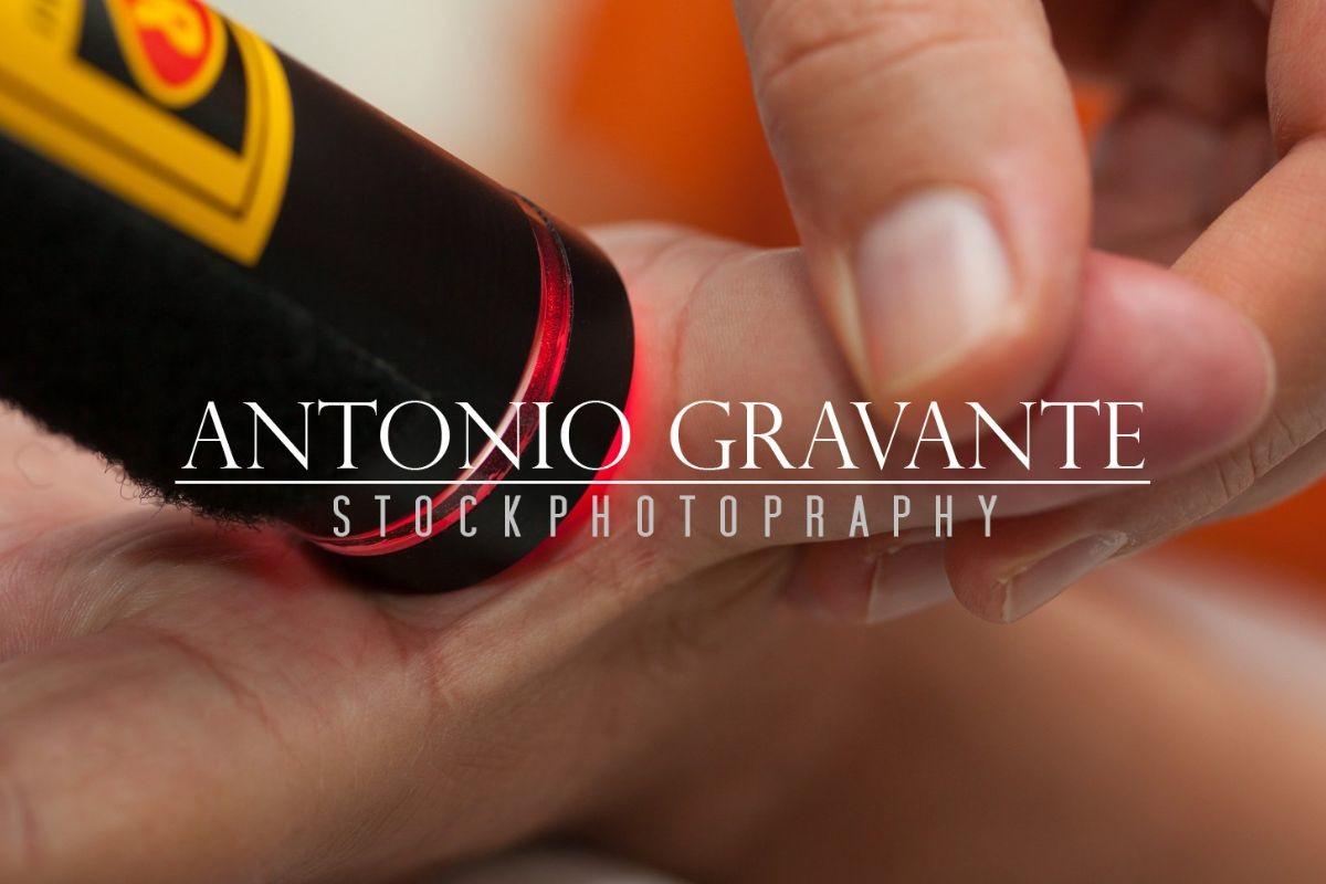 Laser Therapy to the Thumb